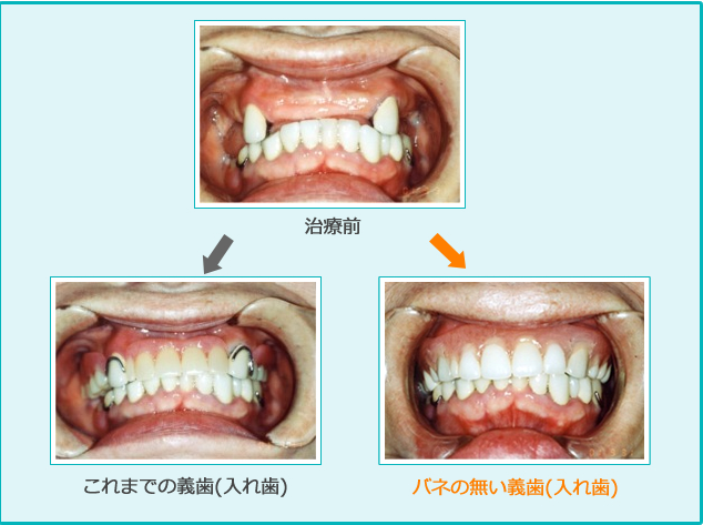 治療前　これまでの義歯(入れ歯)　バネの無い義歯(入れ歯)