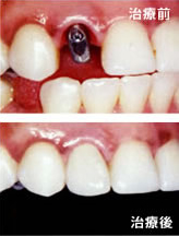 インプラント治療イメージ