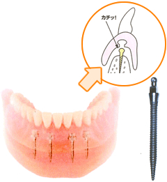 ミニインプラント