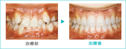 矯正治療 乱くい歯 症例 