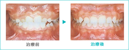 矯正治療 受け口 症例